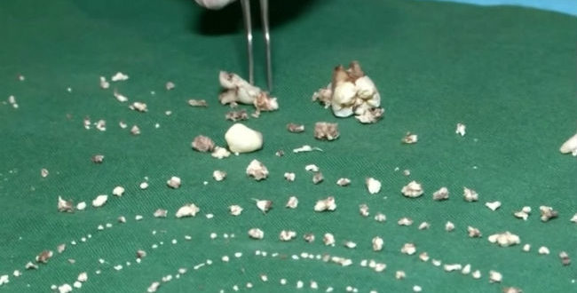 Απίστευτο: Γιατροί αφαίρεσαν 526 δόντια από το στόμα 7χρονου