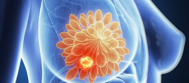 Επιστήμονες μετέτρεψαν τα κύτταρα του καρκίνου του μαστού σε λίπος